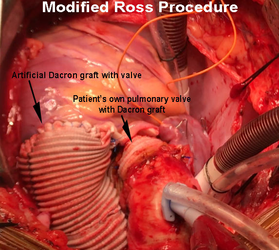 Dacron Graft Enforced Modified Ross Procedure at KLES Dr Prabhakar Kore Hospital, Belagavi  